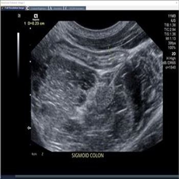 Intestinal Ultrasound: A New Approach to Monitoring Inflammatory Bowel Disease