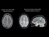 Innovative strategies for pediatric epilepsy